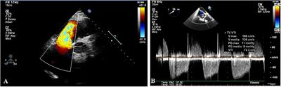 Percutaneous Valve-in-Valve Treatment of a (Very Old and Fluoroscopy Invisible) Degenerated Tricuspid Prosthesis Through the Right Jugular Vein Approach